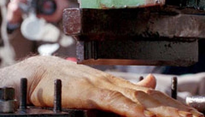 Iran_amputation_limbs_26092020